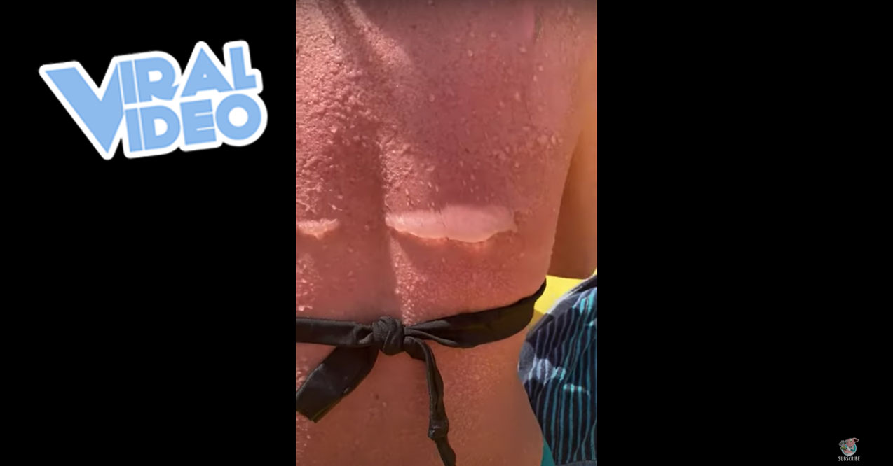 Viral Video: Severe Sunburn Leaves Back Blistered